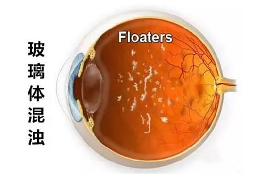 玻璃体是一种透明状物,充填于眼球后部,对眼球有保护作用.
